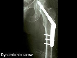 Click image for larger version Name: Dynamic_hip_screw_2.jpg Views: 248 Size: 7.0 KB ID: 10264
